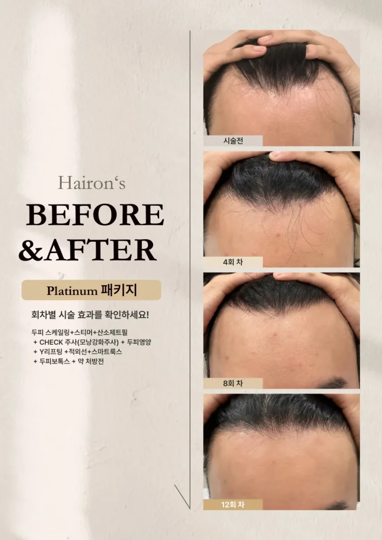 플래티넘 패키지 4회, 8회, 12회 시술 후 헤어라인 변화 전후 사진