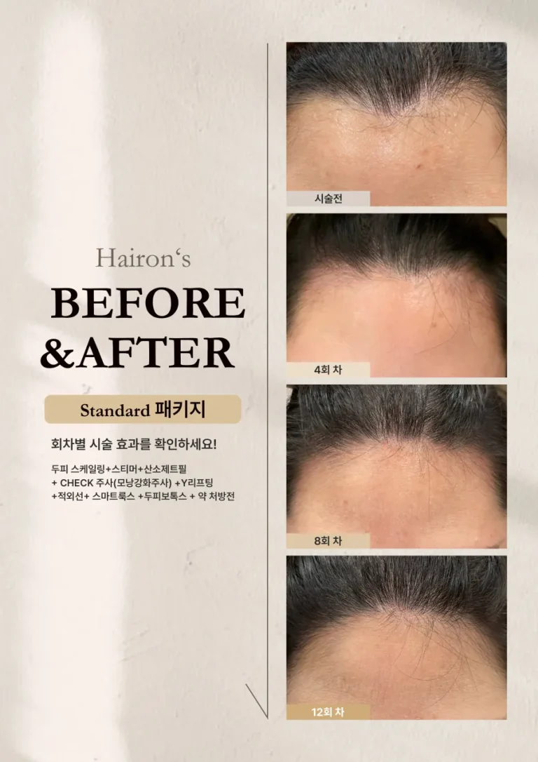 스탠다드 패키지 4회, 8회, 12회 시술 후 헤어라인 변화 전후 사진