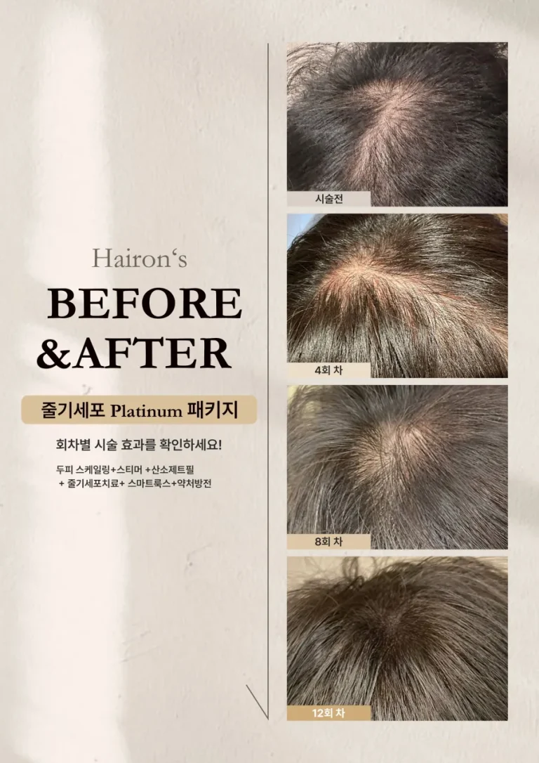 줄기세포 플래티넘 패키지 4회, 8회, 12회 시술 후 정수리 변화 전후 사진